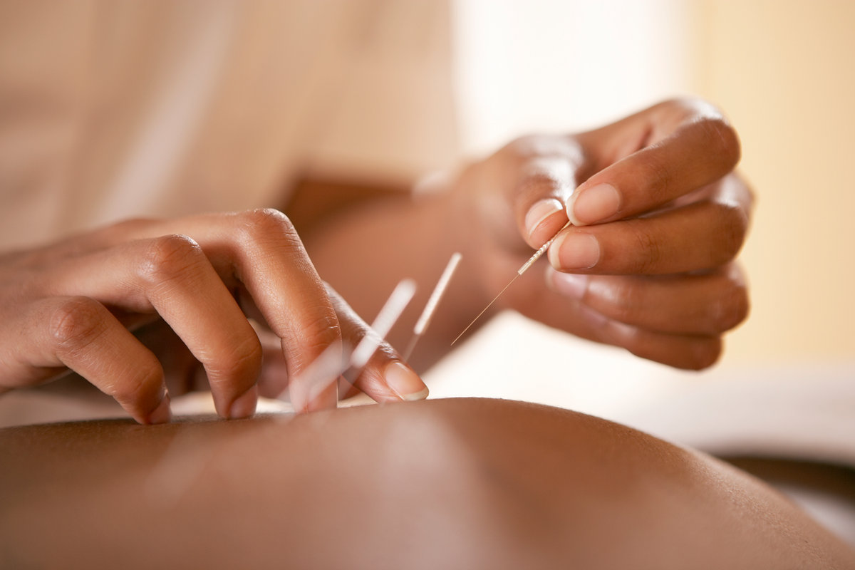 Acupuncture needles being placed
