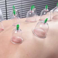 Close-up of cupping therapy in progress with clear suction cups on client's back